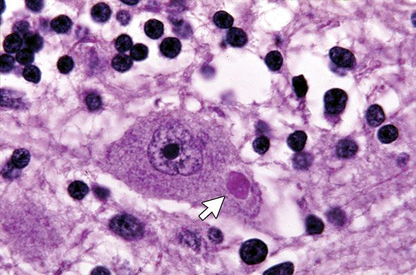 Neuron_with_a_Negri_body_ET-2309-F2