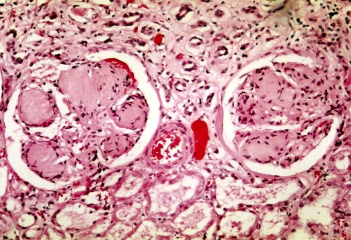 Nodular_glomerulosclerosis