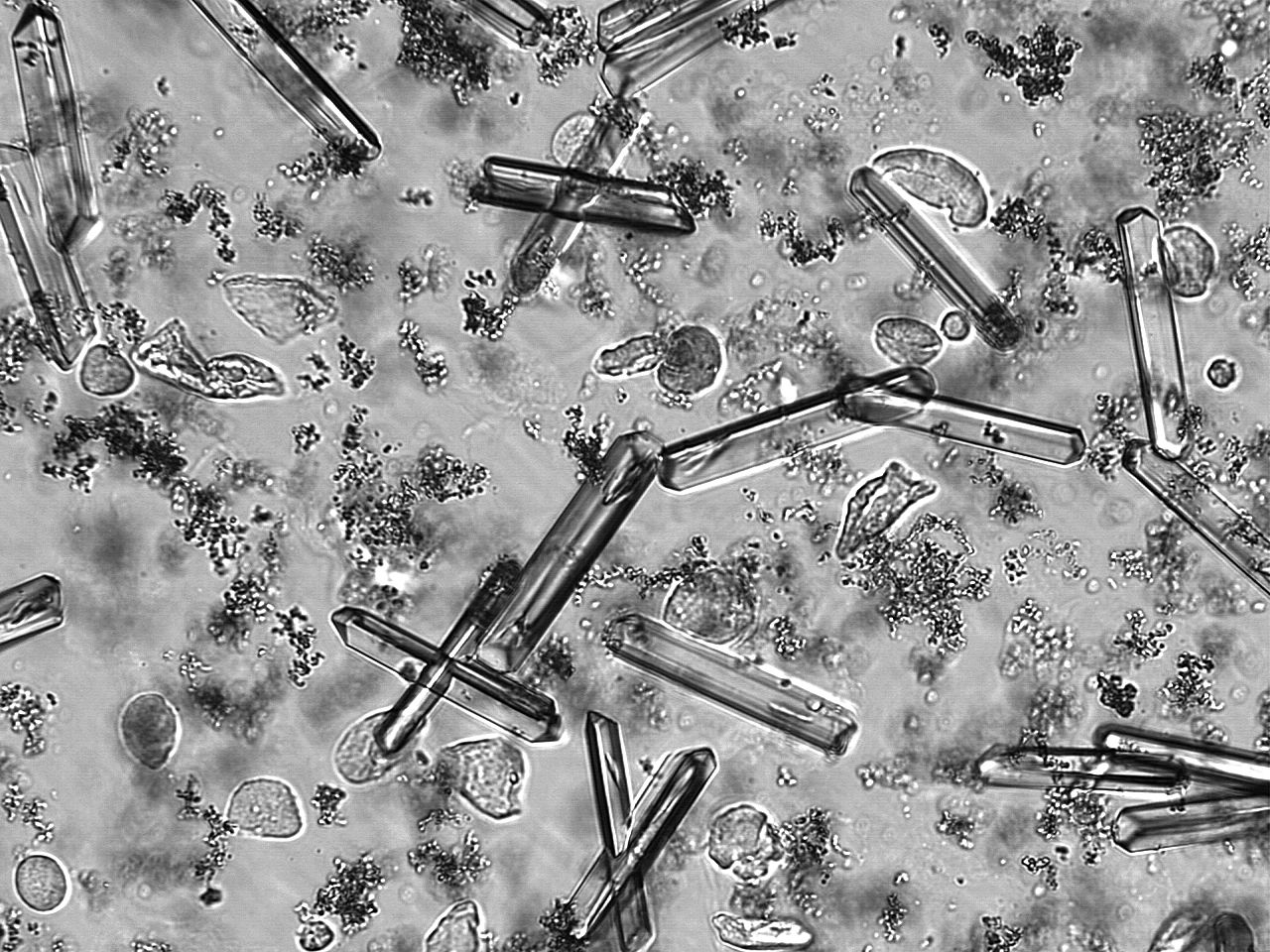 Struvite_crystals_(urine)