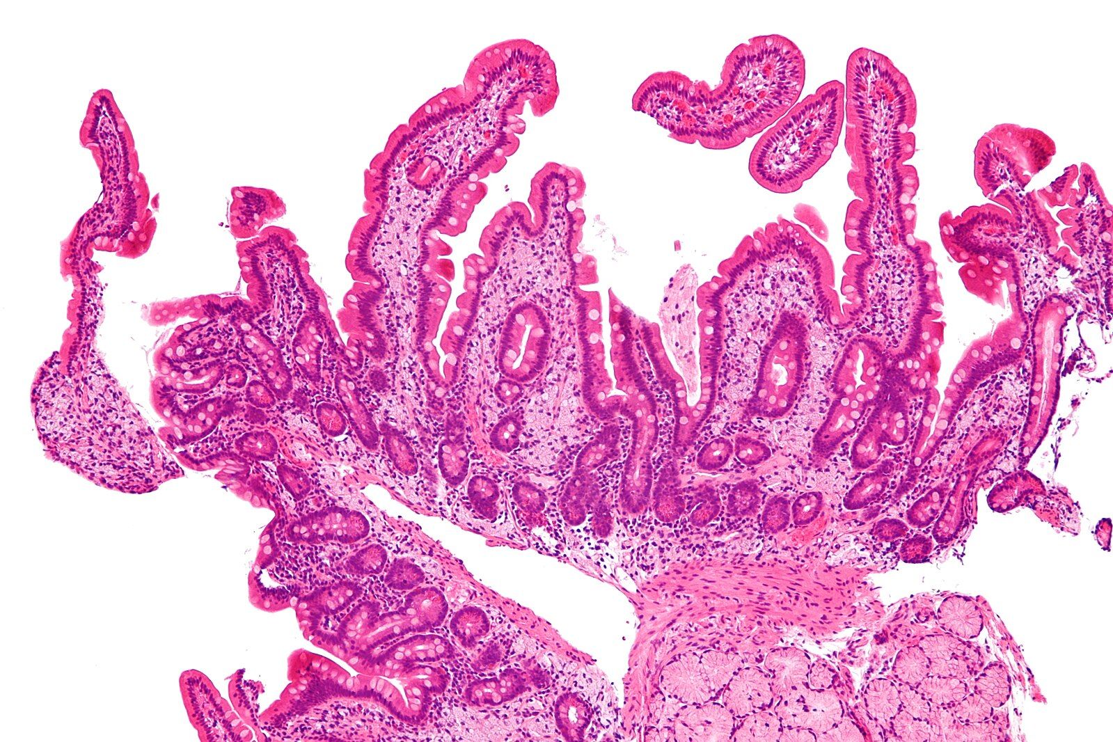 Whipple_disease_-_intermed_mag